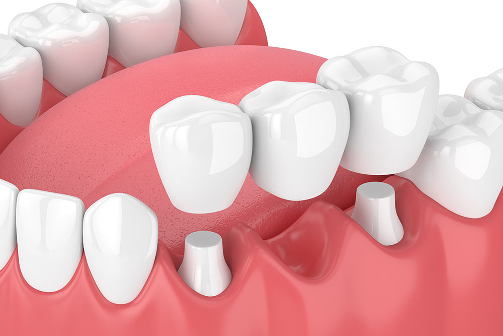Crowns Bridges 3D image