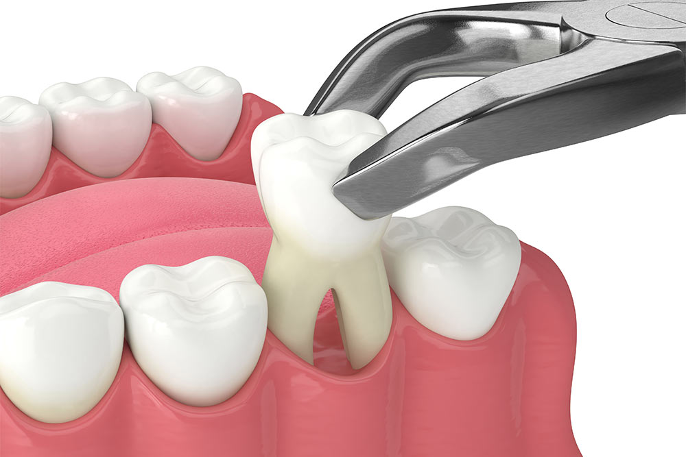 Extractions treatment 3D image