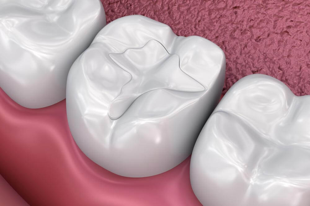 Fillings and bonding 3D image