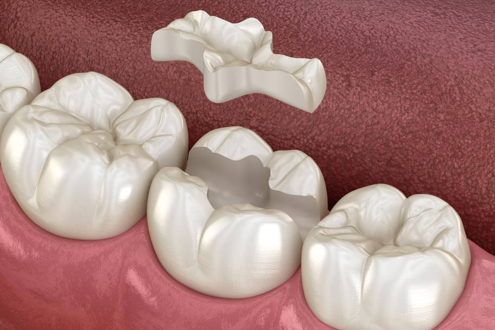 Inlays and onlays 3D image