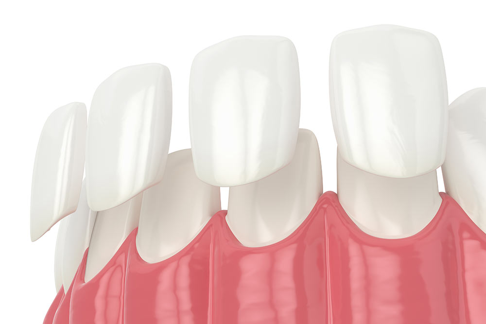 Veneers 3D image