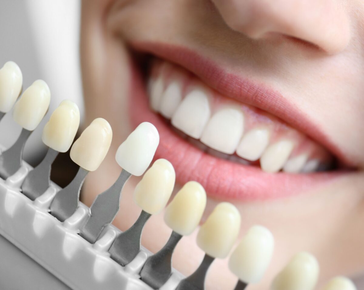 Close up of smile with tooth shade bar in front of it